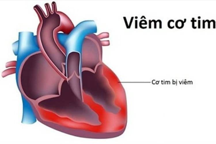 Phần lớn ở các bệnh nhân viêm cơ tim thường không có triệu chứng đặc biệt